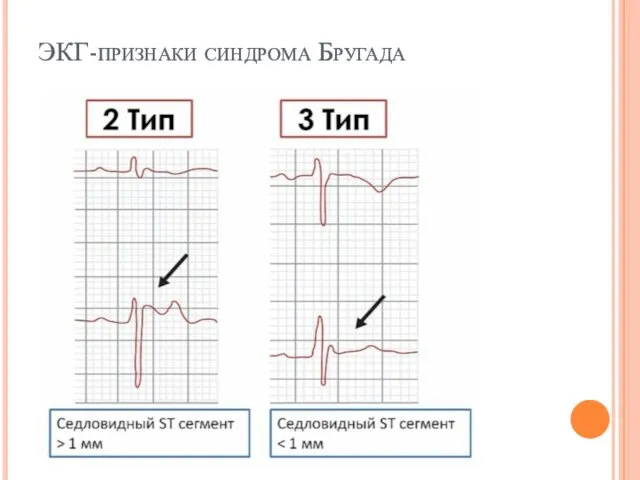 ЭКГ-признаки синдрома Бругада