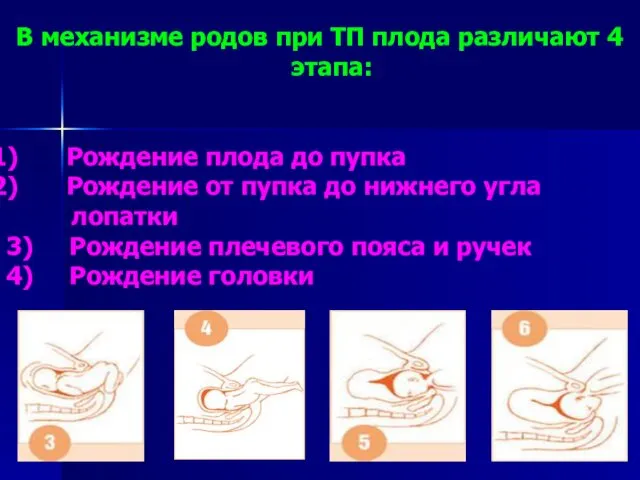 В механизме родов при ТП плода различают 4 этапа: Рождение