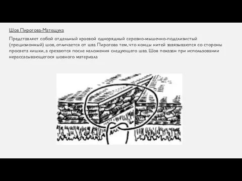 Шов Пирогова-Матещука Представляет собой отдельный краевой однорядный серозно-мышечно-подслизистый (прецизионный) шов,