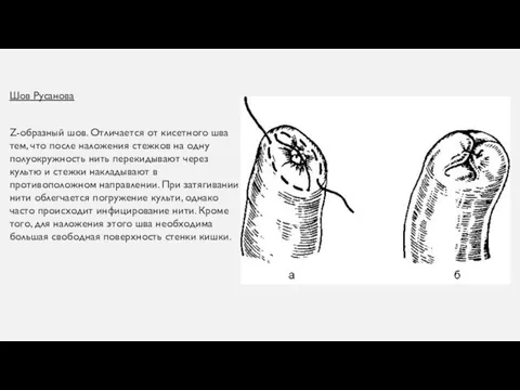 Шов Русанова Ζ-образный шов. Отличается от кисетного шва тем, что