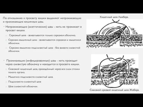 По отношению к просвету кишки выделяют непроникающие и проникающие кишечные