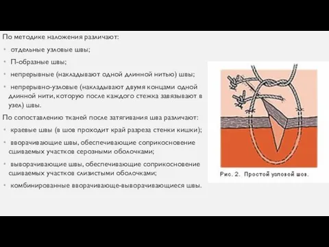 По методике наложения различают: отдельные узловые швы; Π-образные швы; непрерывные