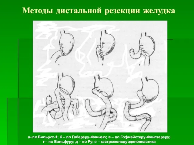 Методы дистальной резекции желудка а- по Бильрот-1; б – по