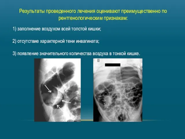 Результаты проведенного лечения оценивают преимущественно по рентгенологическим признакам: 1) заполнение