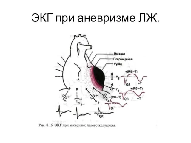 ЭКГ при аневризме ЛЖ.