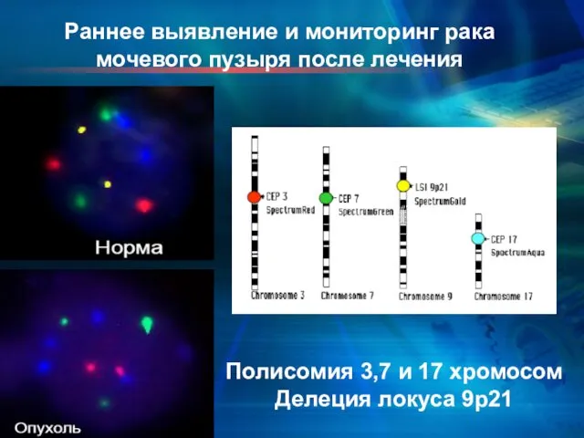 Раннее выявление и мониторинг рака мочевого пузыря после лечения Полисомия