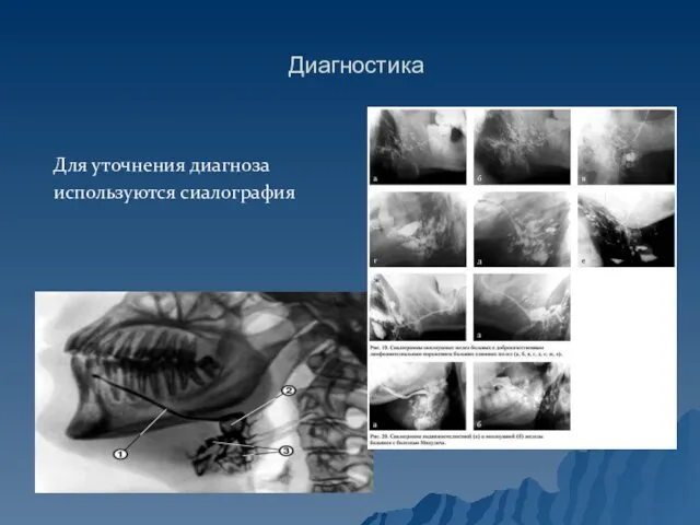 Диагностика Для уточнения диагноза используются сиалография