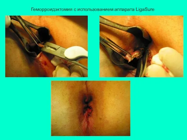 Геморроидэктомия с использованием аппарата LigaSure