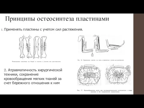 Принципы остеосинтеза пластинами 1. Применять пластины с учетом сил растяжения.