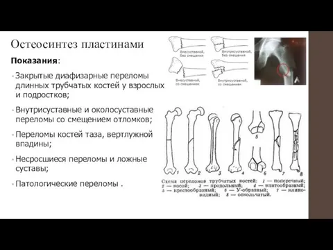 Остеосинтез пластинами Показания: Закрытые диафизарные переломы длинных трубчатых костей у