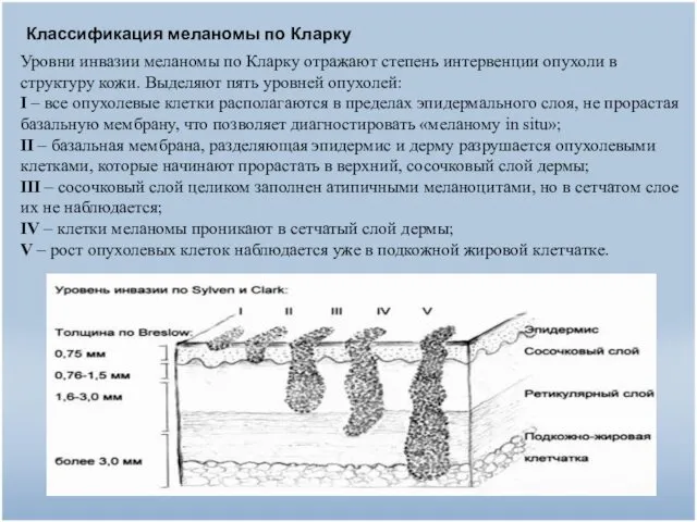 Классификация меланомы по Кларку Уровни инвазии меланомы по Кларку отражают степень интервенции опухоли