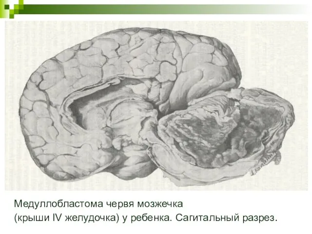 Медуллобластома червя мозжечка (крыши IV желудочка) у ребенка. Сагитальный разрез.