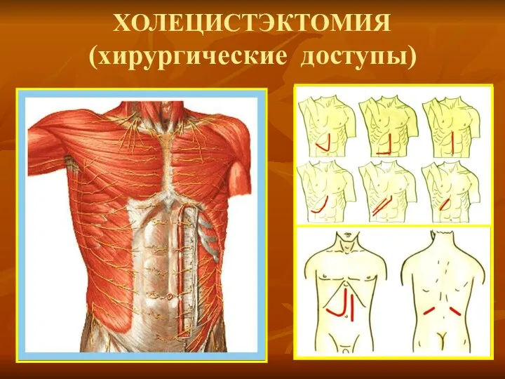 ХОЛЕЦИСТЭКТОМИЯ (хирургические доступы)