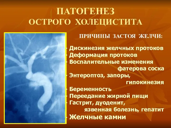 ПАТОГЕНЕЗ ОСТРОГО ХОЛЕЦИСТИТА ПРИЧИНЫ ЗАСТОЯ ЖЕЛЧИ: Дискинезия желчных протоков Деформация