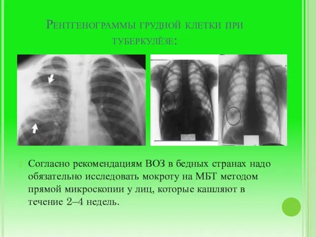 Рентгенограммы грудной клетки при туберкулёзе: Согласно рекомендациям ВОЗ в бедных