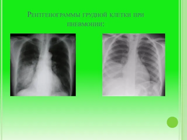 Рентгенограммы грудной клетки при пневмонии: