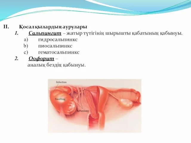 Қосалқылардың аурулары Сальпингит – жатыр түтігінің шырышты қабатының қабынуы. гидросальпинкс