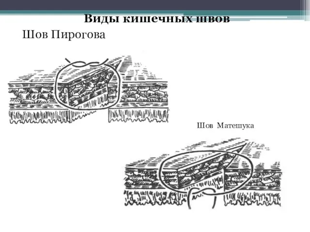 Виды кишечных швов Шов Пирогова Шов Матешука