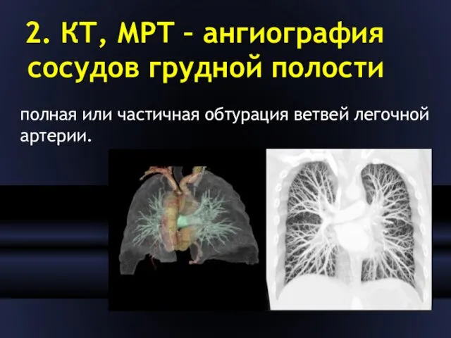 2. КТ, МРТ – ангиография сосудов грудной полости полная или частичная обтурация ветвей легочной артерии.