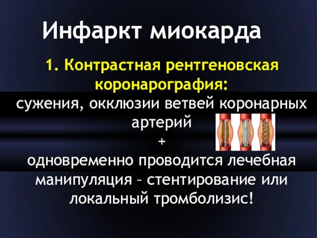 1. Контрастная рентгеновская коронарография: сужения, окклюзии ветвей коронарных артерий +