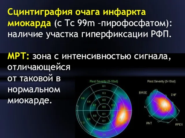 Сцинтиграфия очага инфаркта миокарда (с Tc 99m –пирофосфатом): наличие участка