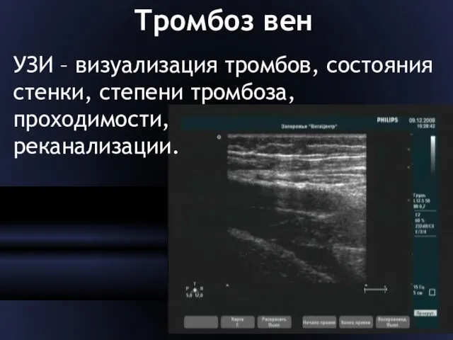 Тромбоз вен УЗИ – визуализация тромбов, состояния стенки, степени тромбоза, проходимости, реканализации.