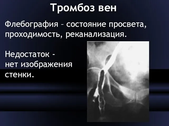 Тромбоз вен Флебография – состояние просвета, проходимость, реканализация. Недостаток - нет изображения стенки.