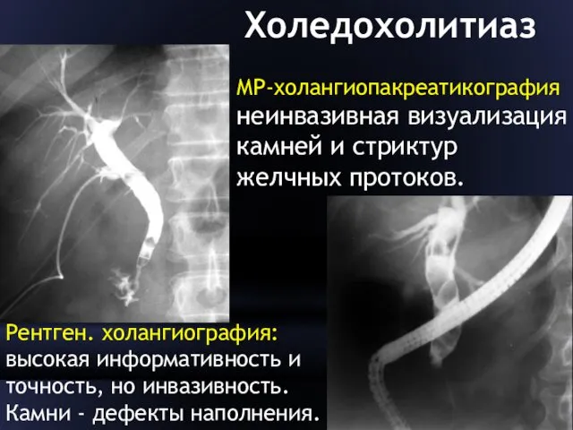 Холедохолитиаз Рентген. холангиография: высокая информативность и точность, но инвазивность. Камни