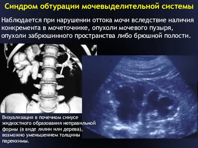 Синдром обтурации мочевыделительной системы Наблюдается при нарушении оттока мочи вследствие