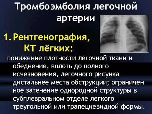 Тромбоэмболия легочной артерии Рентгенография, КТ лёгких: понижение плотности легочной ткани