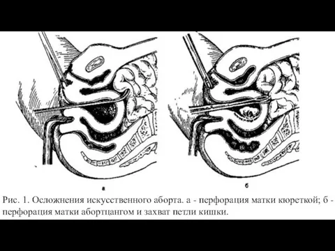 Рис. 1. Осложнения искусственного аборта. а - перфорация матки кюреткой;