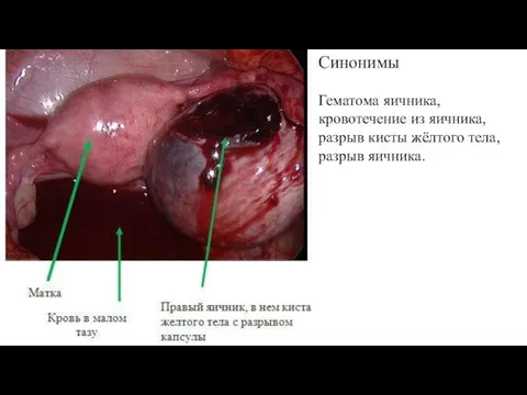 Синонимы Гематома яичника, кровотечение из яичника, разрыв кисты жёлтого тела, разрыв яичника.