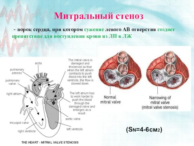 Митральный стеноз - порок сердца, при котором сужение левого АВ