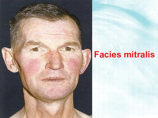 Facies mitralis