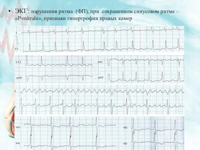ЭКГ: нарушения ритма (ФП), при сохраненном синусовом ритме – «P-mitrale», признаки гипертрофии правых камер