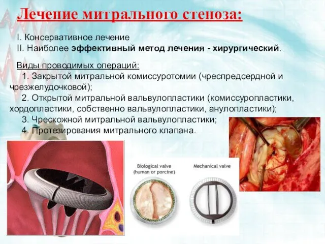 Лечение митрального стеноза: I. Консервативное лечение II. Наиболее эффективный метод