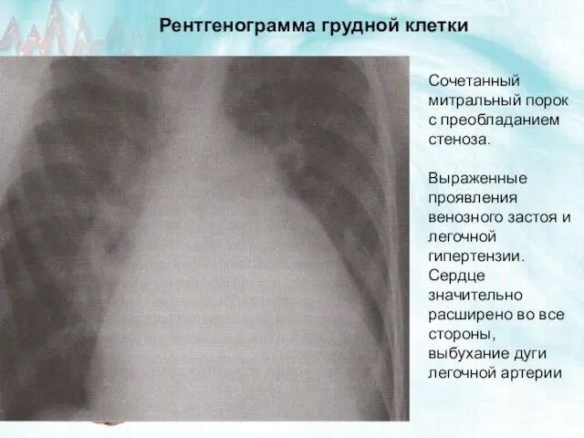 Сочетанный митральный порок с преобладанием стеноза. Выраженные проявления венозного застоя