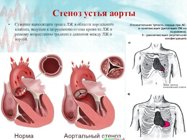 Стеноз устья аорты Сужение выносящего тракта ЛЖ в области аортального