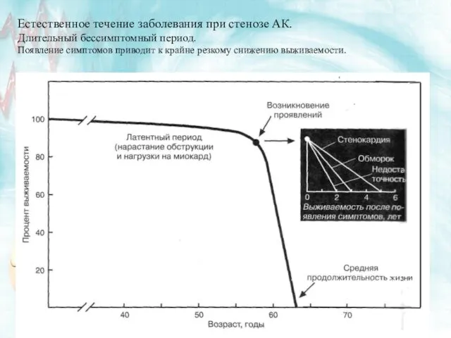 Естественное течение заболевания при стенозе АК. Длительный бессимптомный период. Появление