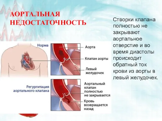 АОРТАЛЬНАЯ НЕДОСТАТОЧНОСТЬ Створки клапана полностью не закрывают аортальное отверстие и