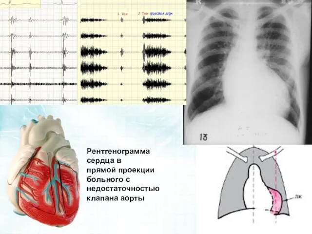 Рентгенограмма сердца в прямой проекции больного с недостаточностью клапана аорты