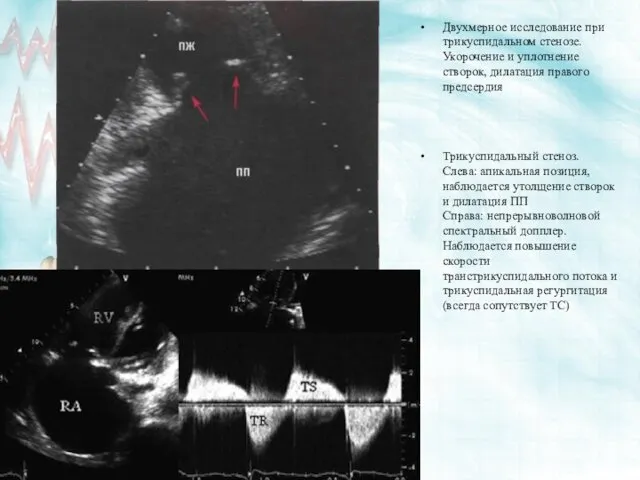 Двухмерное исследование при трикуспидальном стенозе. Укорочение и уплотнение створок, дилатация