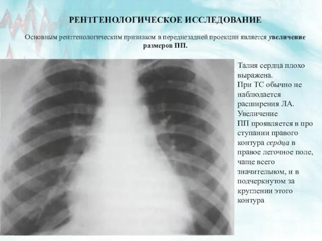 РЕНТГЕНОЛОГИЧЕСКОЕ ИССЛЕДОВАНИЕ Основным рентгенологическим признаком в переднезадней проекции является увеличение