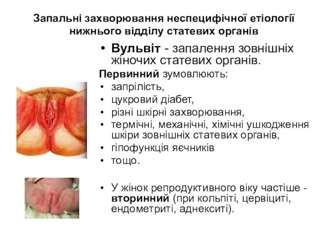 Запальні захворювання неспецифічної етіології нижнього відділу статевих органів Вульвіт -