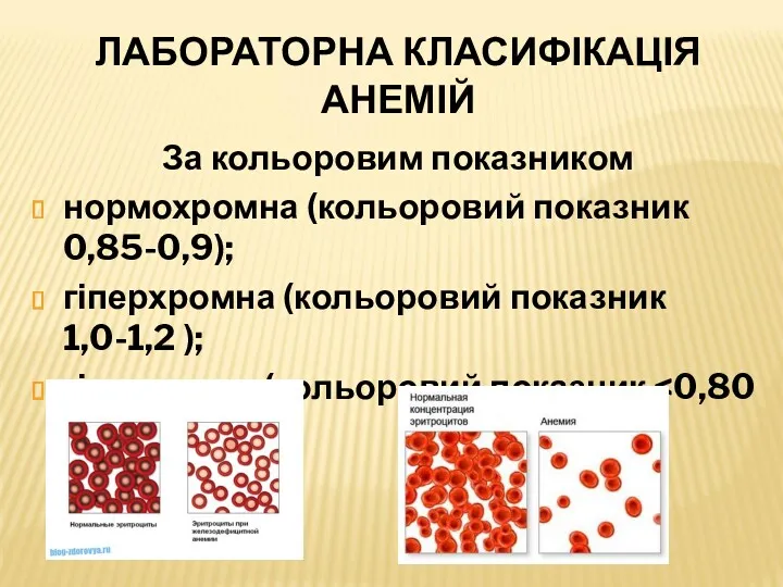 ЛАБОРАТОРНА КЛАСИФІКАЦІЯ АНЕМІЙ За кольоровим показником нормохромна (кольоровий показник 0,85-0,9);