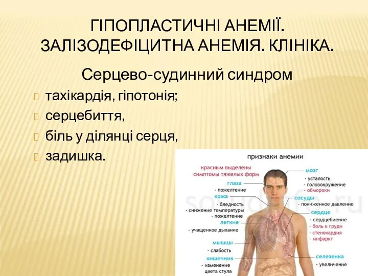 ГІПОПЛАСТИЧНІ АНЕМІЇ. ЗАЛІЗОДЕФІЦИТНА АНЕМІЯ. КЛІНІКА. Серцево-судинний синдром тахікардія, гіпотонія; серцебиття, біль у ділянці серця, задишка.