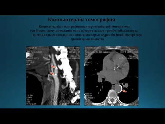Компьютерлік томография Компьютерлік томографияның мүмкіндіктері: аневризма; туа біткен даму аномалия; өкпе артериясының тромбоэмболиялары;