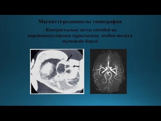 Магнитті-резонансты томография - Контрастылык затты енгізбей-ақ кардиоваскулярлық құрылымды көзбен шолуға мүмкіндік береді