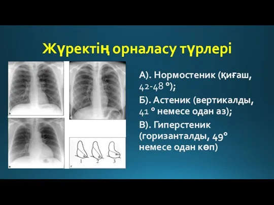 Жүректің орналасу түрлері А). Нормостеник (қиғаш, 42-48 °); Б). Астеник (вертикалды, 41 °