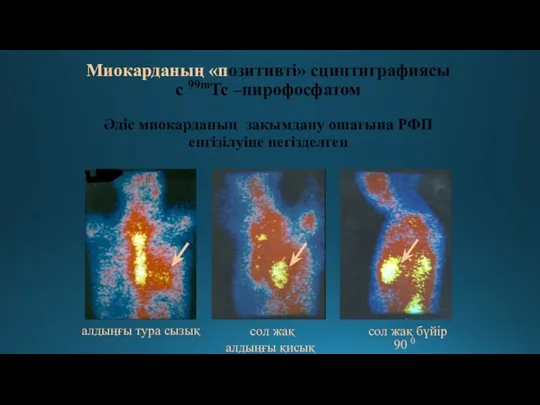 Миокарданың «позитивті» сцинтиграфиясы с 99mTc –пирофосфатом Әдіс миокарданың зақымдану ошағына РФП енгізілуіне негізделген